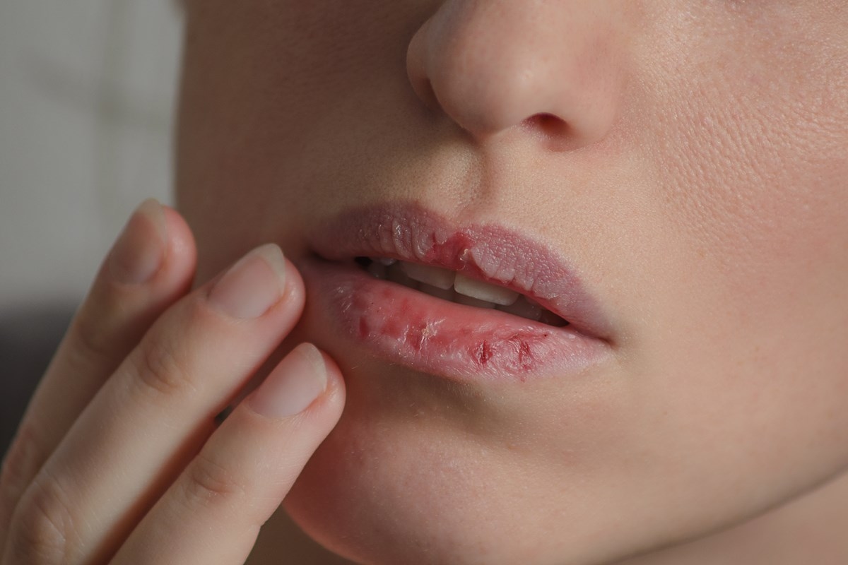 Schützen Sie Ihre Lippen vor Kälte: 4 gute und günstige Feuchtigkeitscremes für bis zu 30 R$