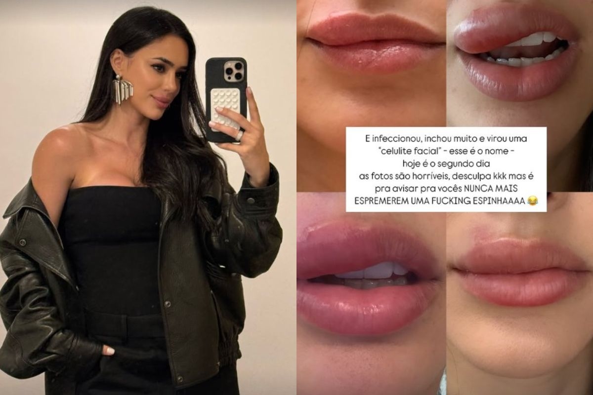 Wat is gezichtscellulitis, een ernstige infectie onthuld door Bruna Biancardi